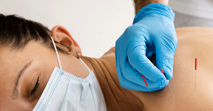 Dry Needling in Physiotherapy