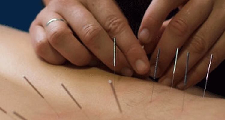 Dry needling  therapeutic procedure