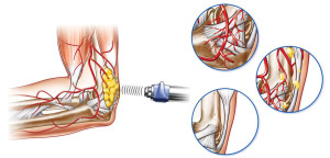 The Radial Shockwave Therapy Procedure